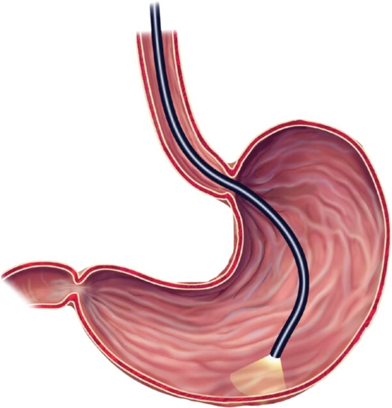 Endoscopy (Upper GI) Texas Gastroenterology Center PLLC